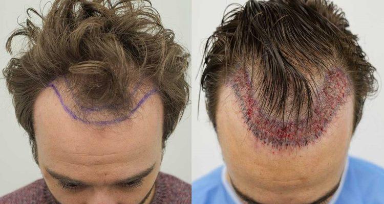 After Care for Hair Transplant