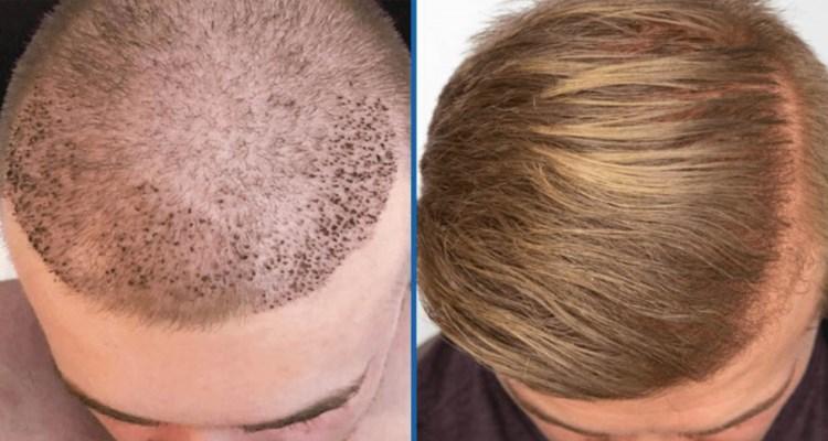 Weaving Hair- Difference Between Hair Weaving And Hair Transplant